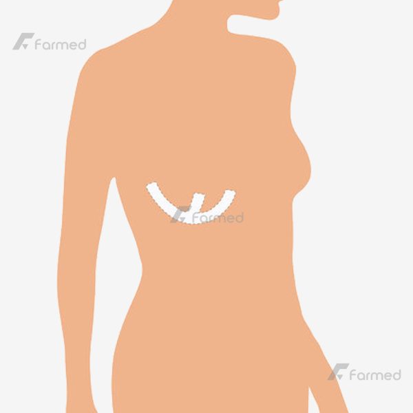 سیلیکون شیت , سیلیکون شیت آنتی اسکار , ورقه سیلیکونی , رفع جای سوختگی , جای بخیه , جای زخم , گوشت اضافه , ماموپلاستی , پروتز سینه , بخیه مامو
